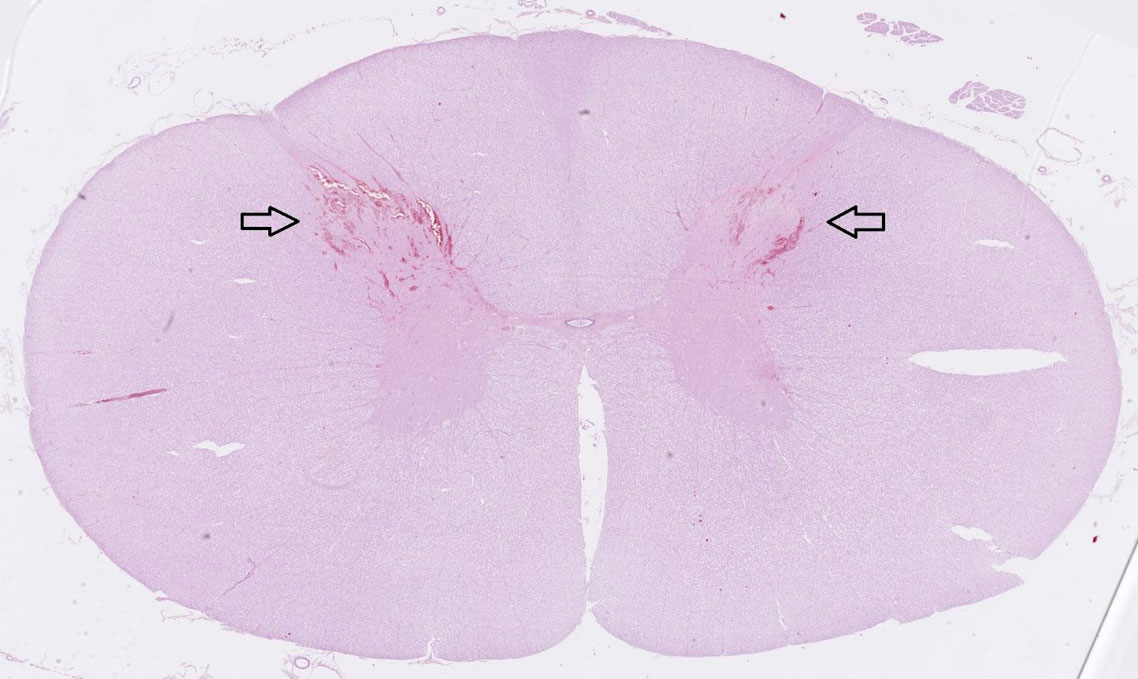 Histologisches Bild des Rückenmarks mit Blutungen in den Dorsalhörnern.
