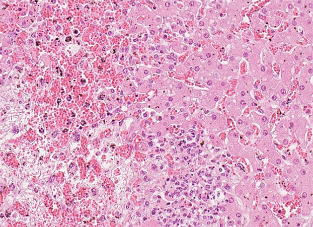 Feingewebliches Bild eines krankheitsbedingt stark veränderten Lebergewebes mit Einblutungen.