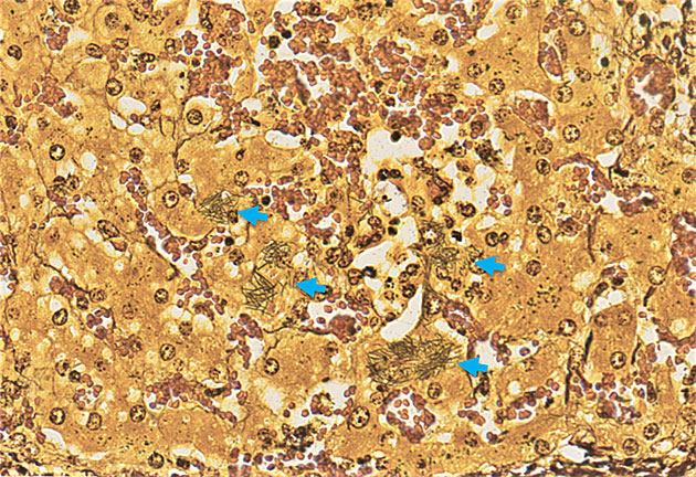 Feingewebliches Bild eines mit Spezialfärbung gefärbten Lebergewebes, in den Leberzellen sind zahlreiche, schwarz angefärbte Bakterien zu sehen.