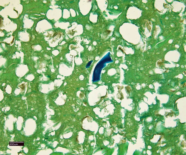 Abb. 5: Histologisches Präparat eines Chicken Nugget: Knochenpartikel (dunkelblau) in fein zerkleinerter Masse.