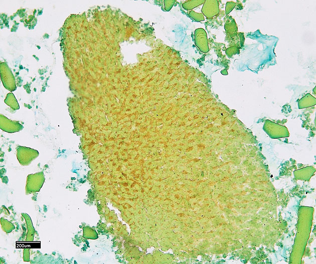 Histologisches Pr�parat: pathologisch ver�ndertes Lebergewebe.